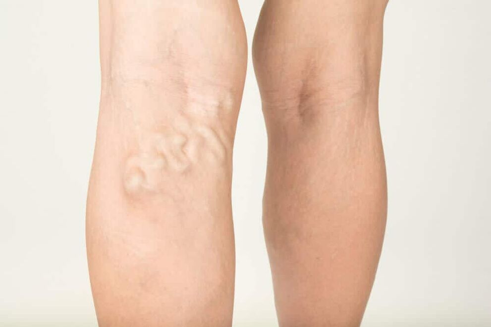 The manifestation of varicose veins