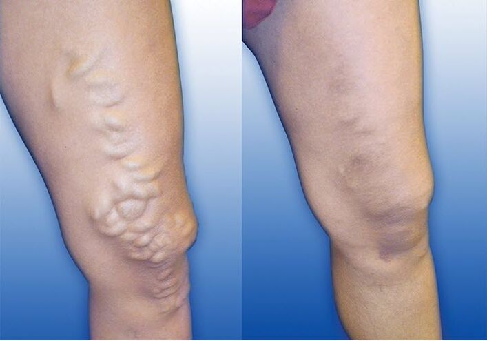 Reasons for varicose veins