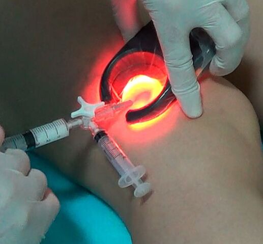 The treatment of varicose veins
