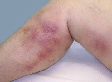Varicosis complications of the veins