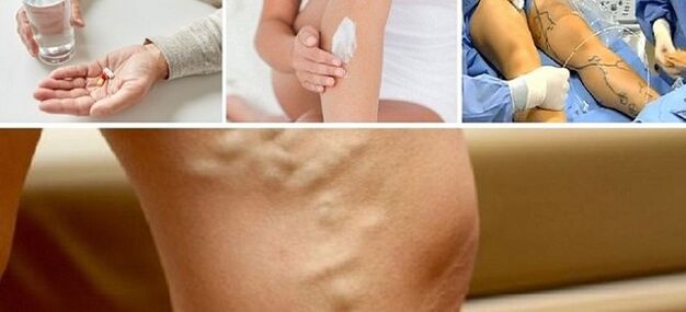 The treatment of varicose veins