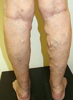 Varicosis veins in the legs