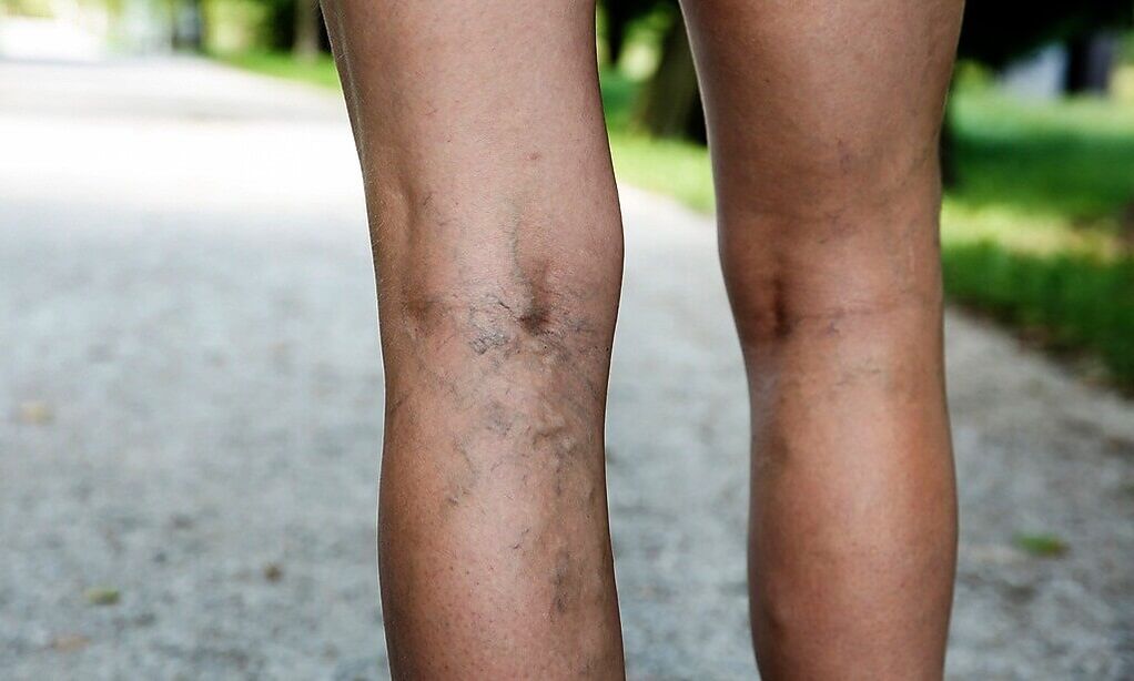 Enlarged veins in the legs