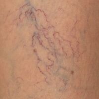 Manners of Varicosis Veins