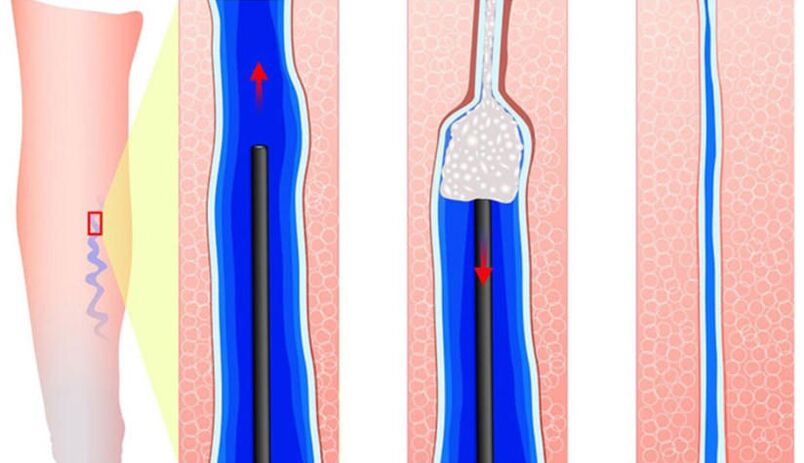 Application of sclerosis in sclerotherapy