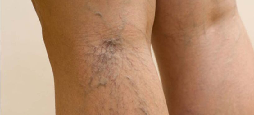 Varicosis veins in the legs