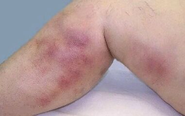 How Varicosis Visions Look