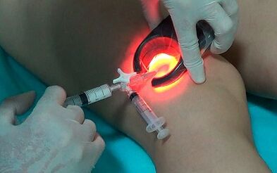 Sclerotherapy as a way of treating varicose veins in feet