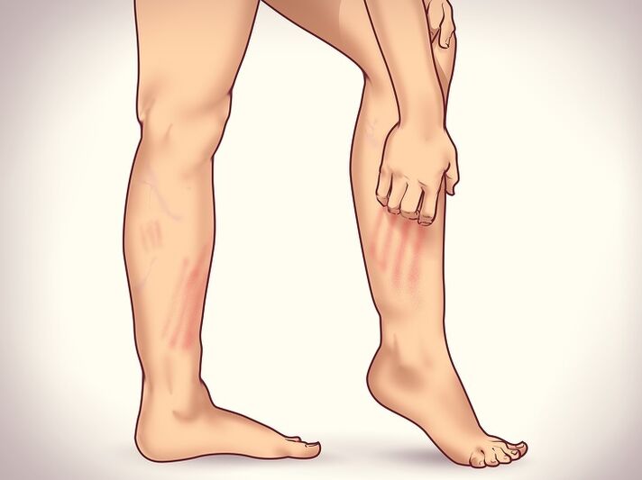 Varicosis vessels in the 6th signs