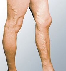 Manners of Varicosis Veins
