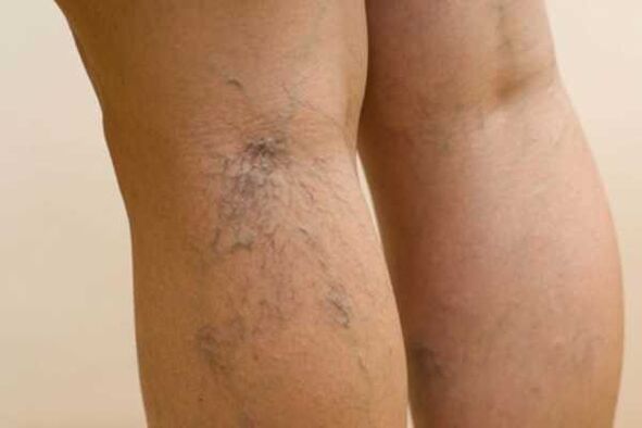 varicose veins in the leg